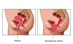 Опущение матки и влагалища