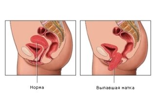 Опущение матки и влагалища