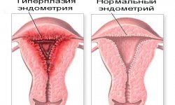 Гиперплазия эндометрия