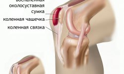Бурсит