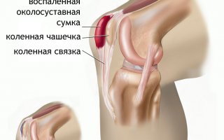 Бурсит