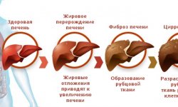 Испанские ученые обнаружили возможный способ лечения цирроза