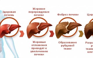 Испанские ученые обнаружили возможный способ лечения цирроза