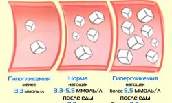 Гипогликемия