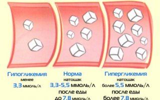 Гипогликемия