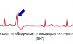 Миокардит