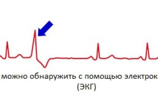 Миокардит