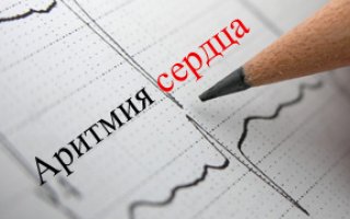 Аритмия