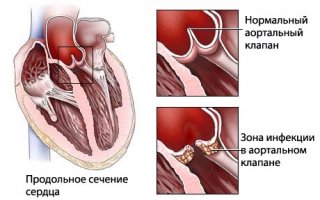 Эндокардит