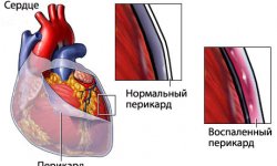 Перикардит