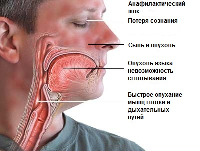 анафилактический шок