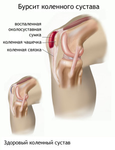 Бурсит