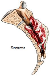 Хордома Хордома