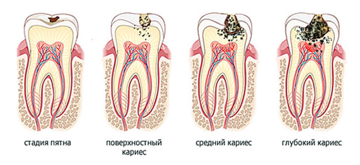 Кариес