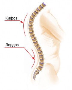 Лордоз Лордоз : симптомы, причины, лечение.