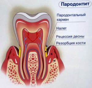 Пародонтит