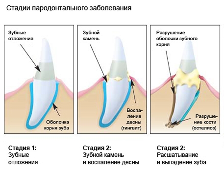 Пародонтоз