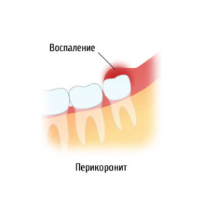 Перикоронит