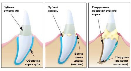Зубной камень