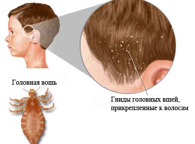 Вши