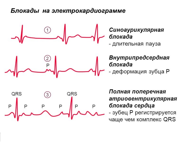 блокады на экг