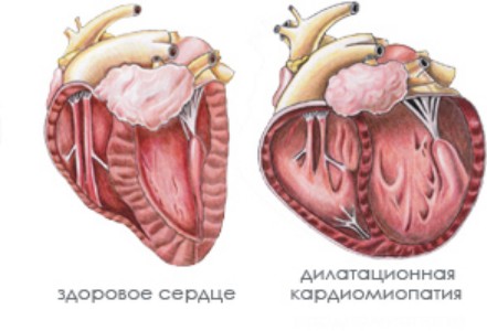 Дилатационная кардиомиопатия