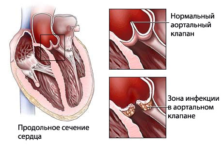 Эндокардит