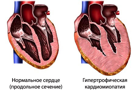 Гипертрофическая кардиомиопатия