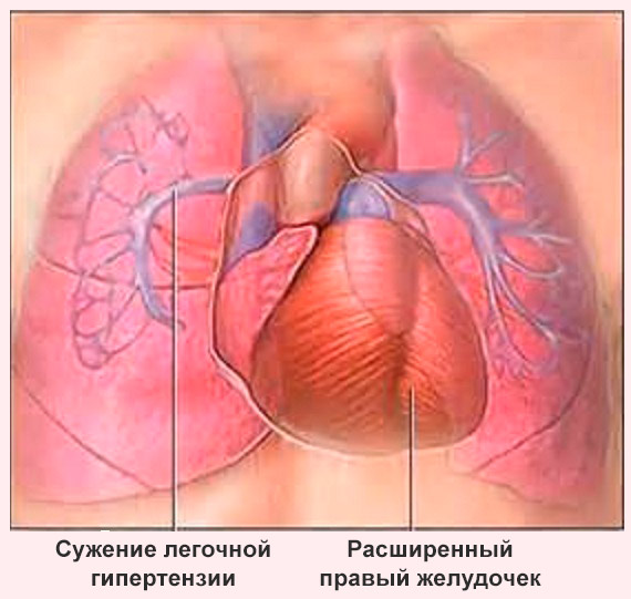 Легочная гипертензия