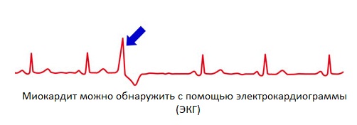Миокардит