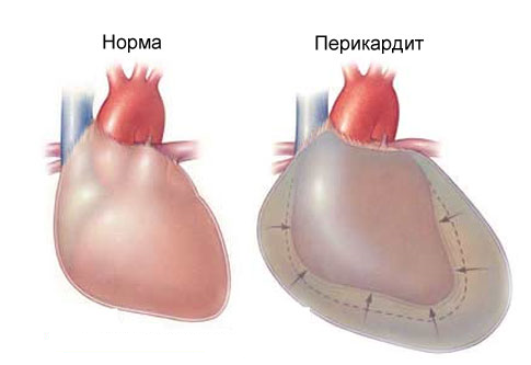 Перикардит