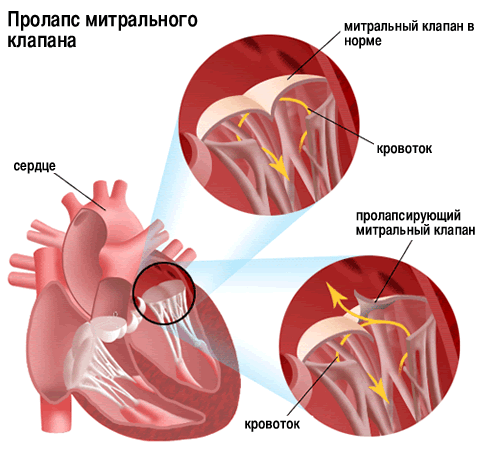 Пролапс митрального клапана