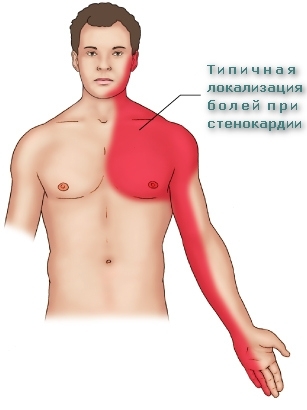 Стенокардия