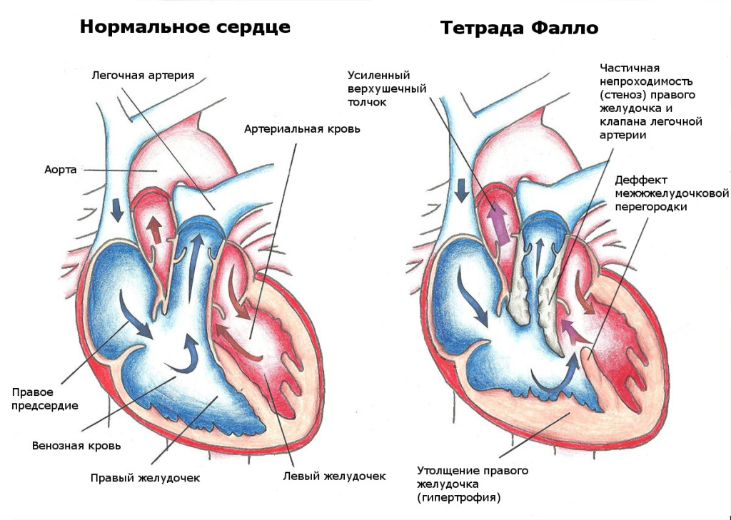 Тетрада Фалло