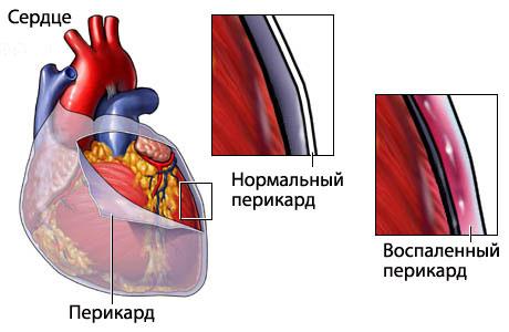 Воспаление перикарда