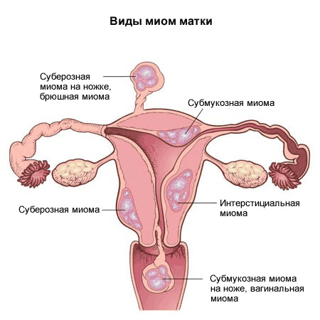 Виды миомы матки Миома матки