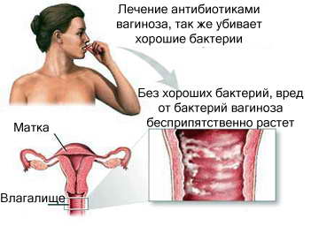 Гарднереллез Гарднереллез (бактериальный вагиноз)