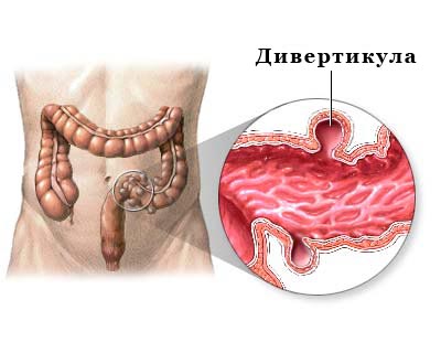 Дивертикулярная болезнь