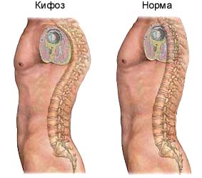 Кифоз Кифоз