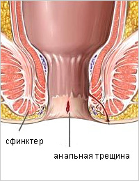 Анальная трещина