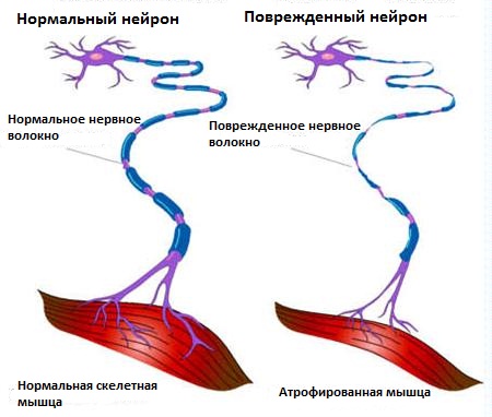 Боковой амиотрофический склероз