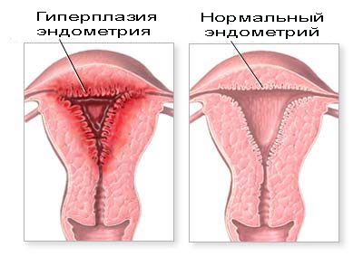 Гиперплазия эндометрия