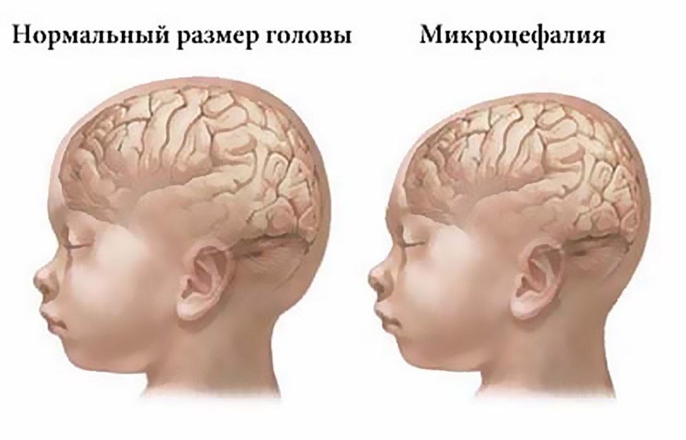 Микроцефалия