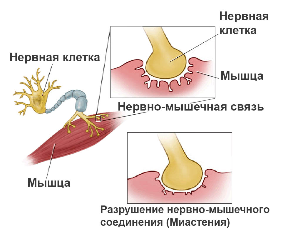 Миастения