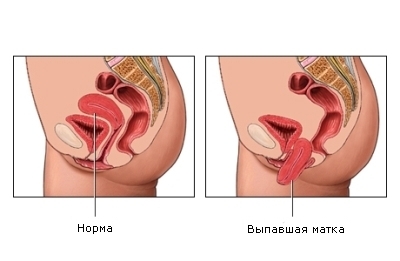 Выпадение матки