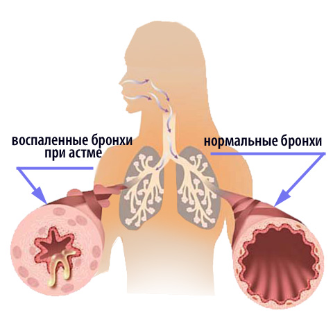 Атопическая форма бронхиальной астмы