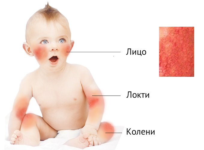 Атопический дерматит у ребенка