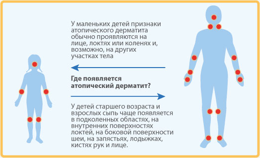 детский атопический дерматит